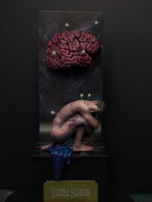 Multiple Sclerosis